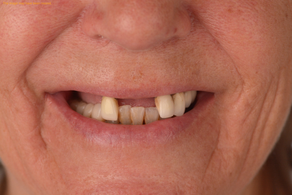 Tooth Replacement result, before
