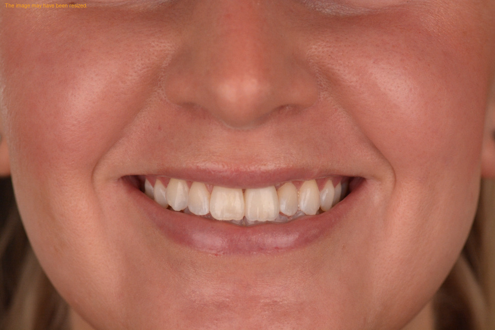 Tooth Replacement result, after