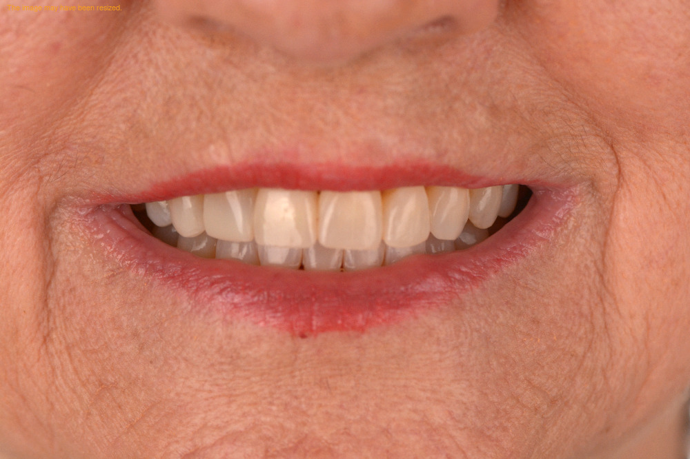 Tooth Replacement result, after