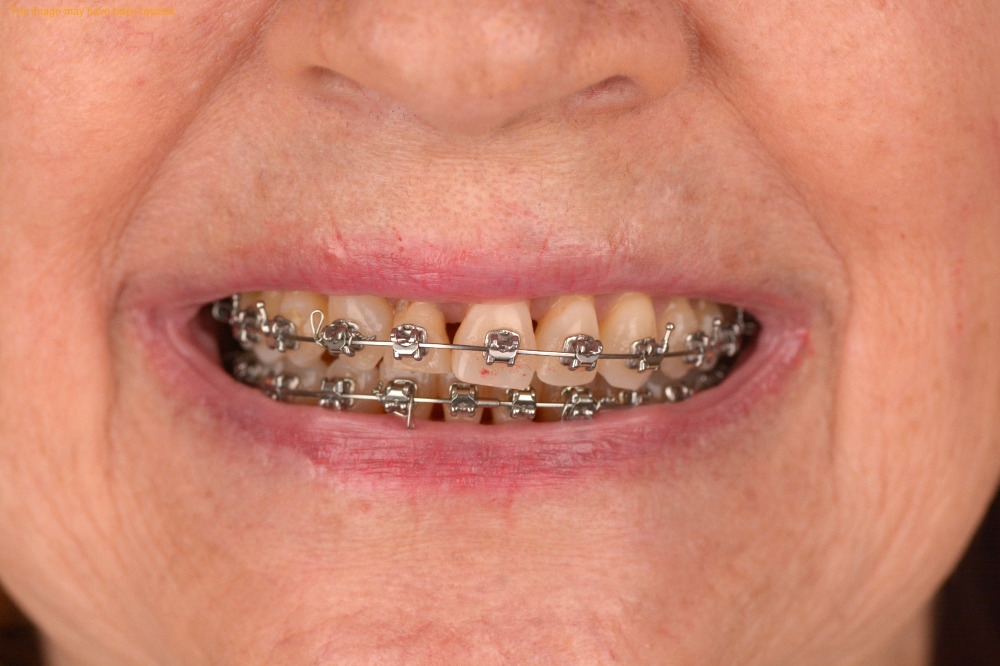 Tooth Replacement result, before
