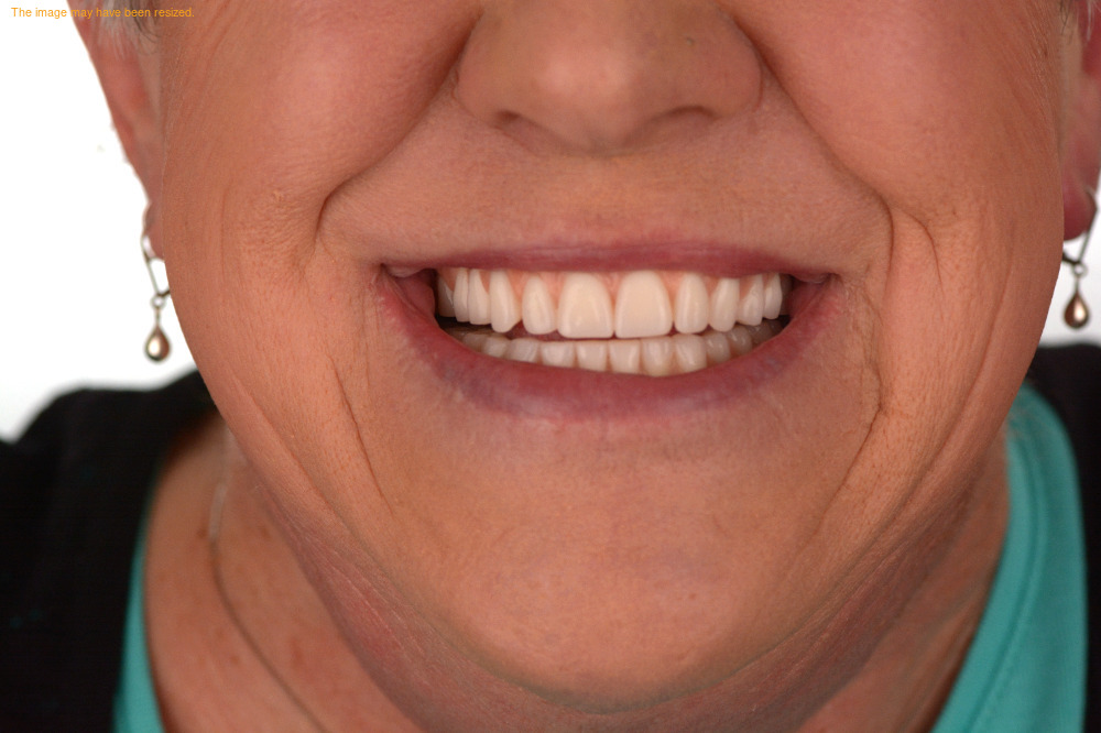 Tooth Replacement case 08, after