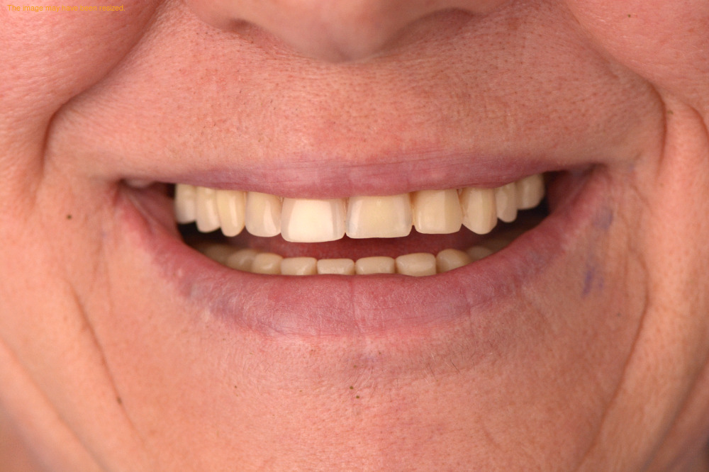 Tooth Replacement case 08, before