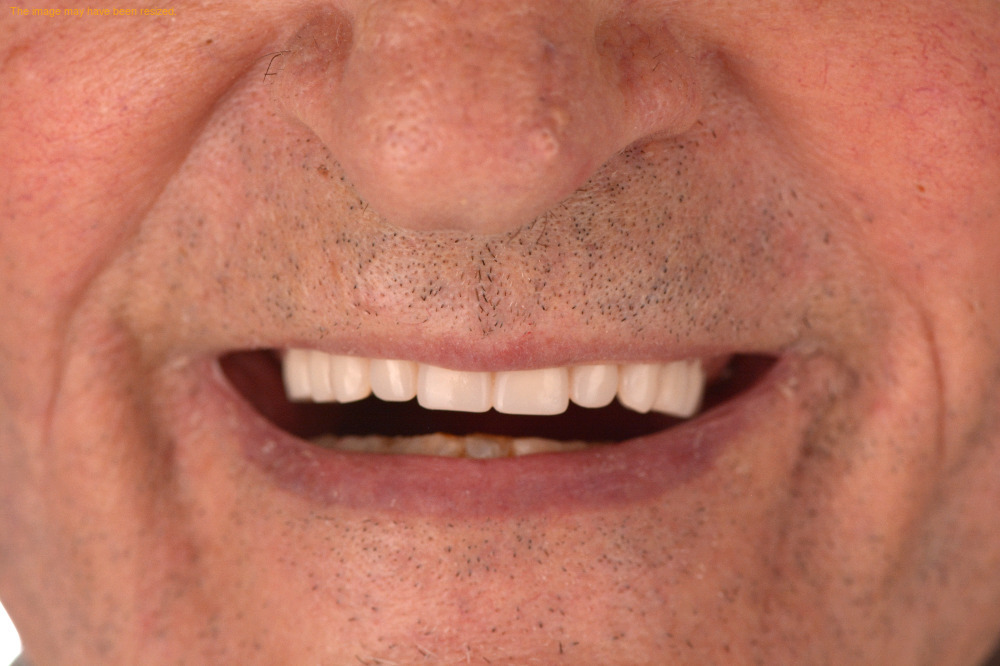 Tooth Replacement result, after