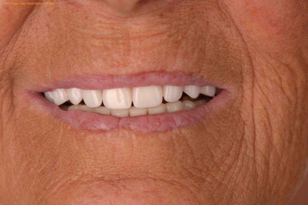 Tooth Replacement result, after