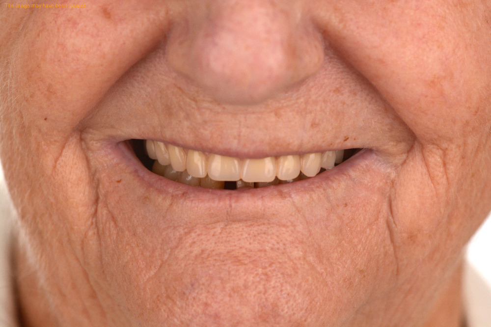 Tooth Replacement case 17, after