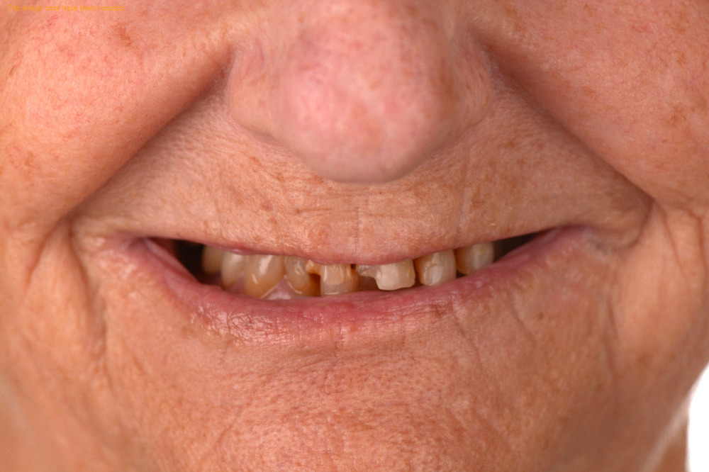 Tooth Replacement case 17, before