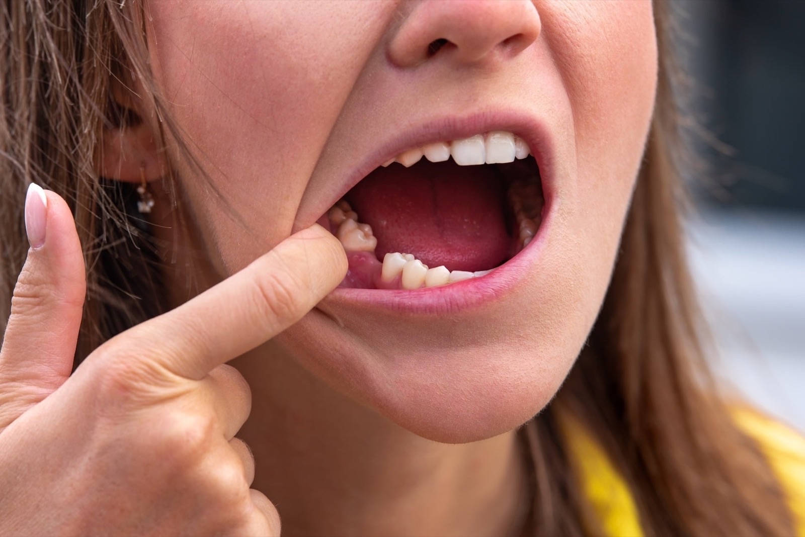 How Missing Teeth Impact More Than Just Your Smile