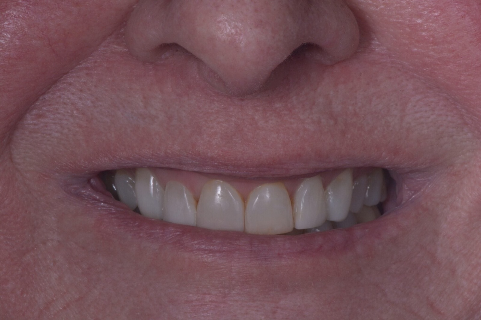 One Arch Dental Implant After