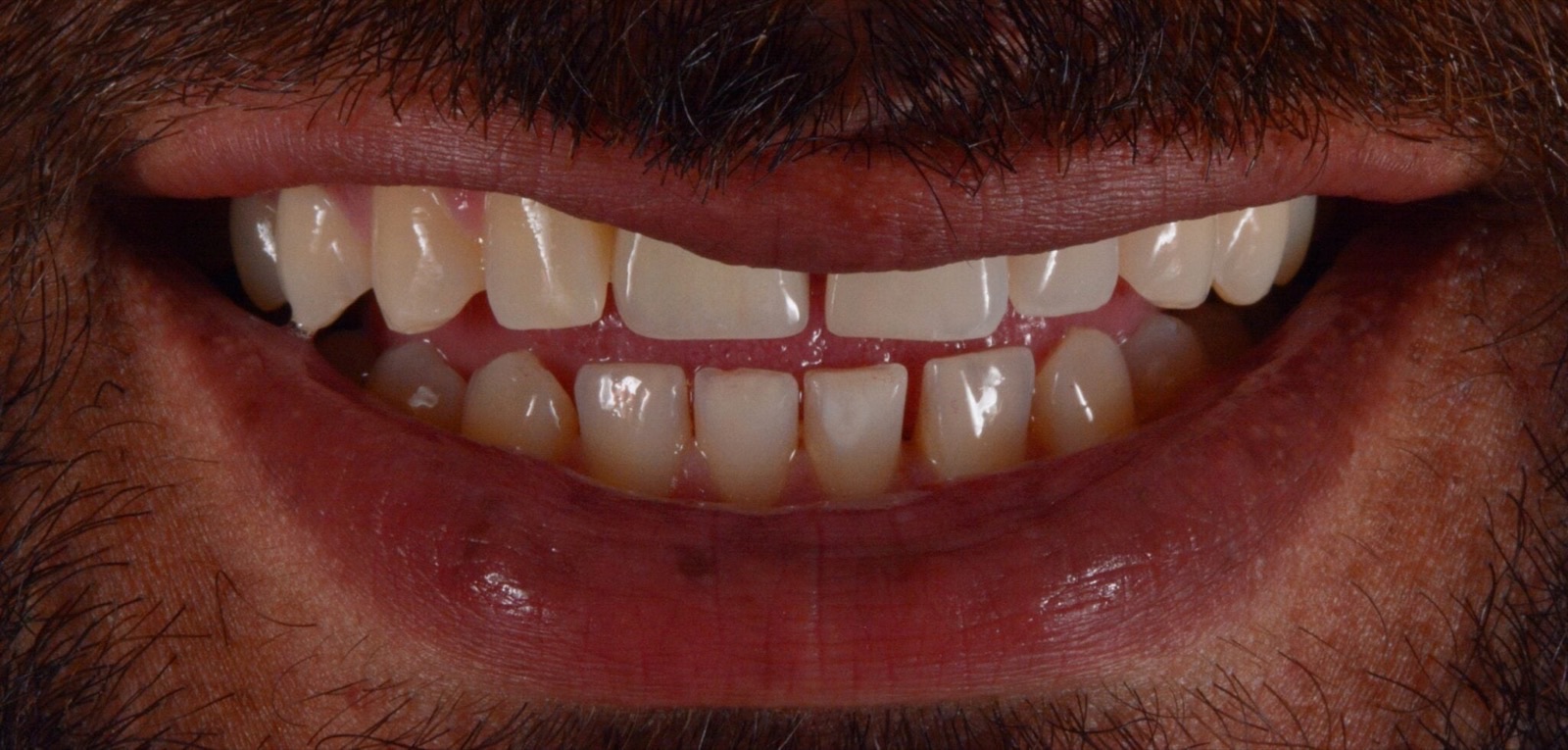 Single Implant After