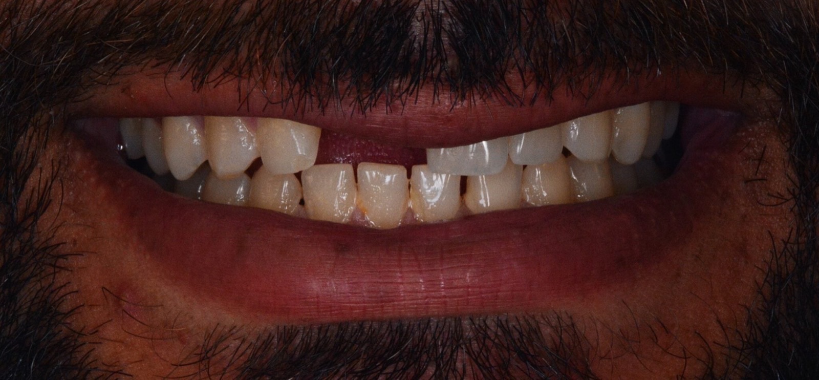 Single implant Before