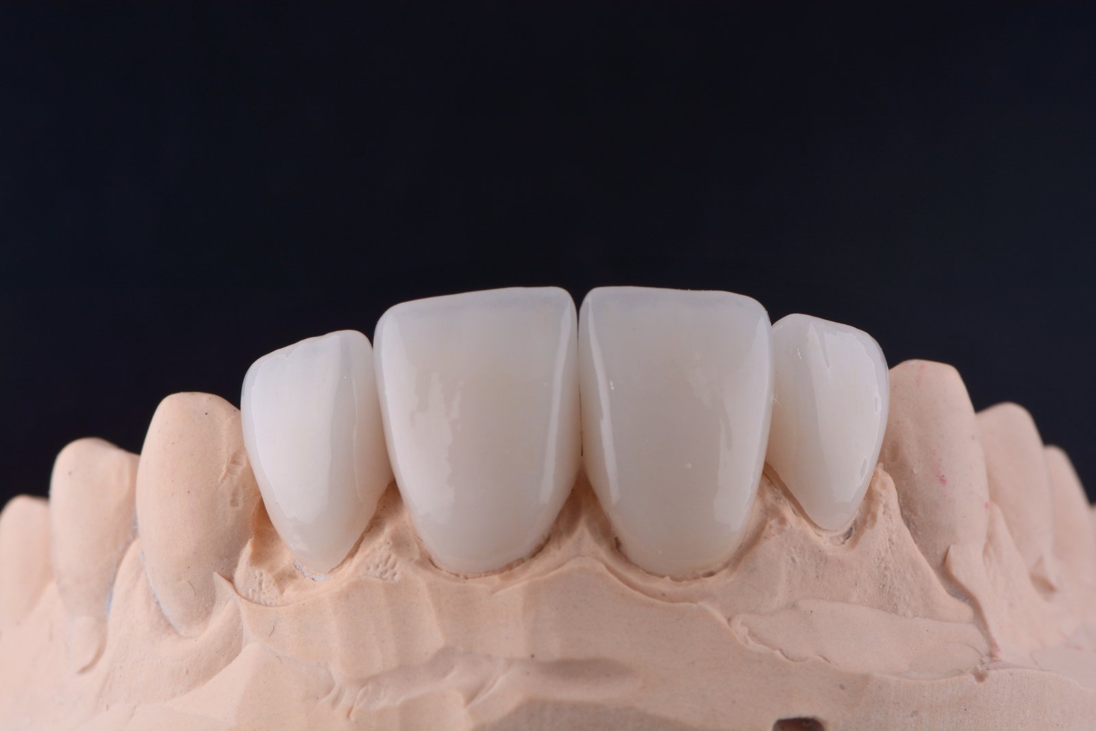 Dental Crowns
