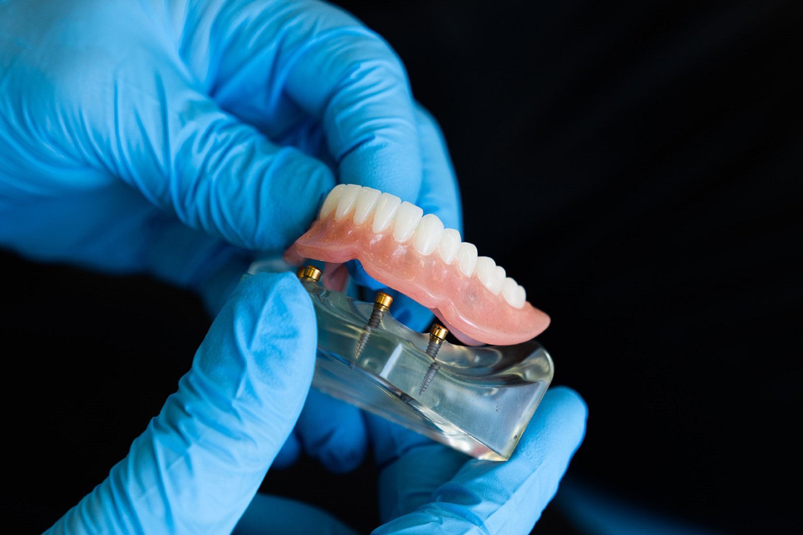 Implant-Supported Dentures