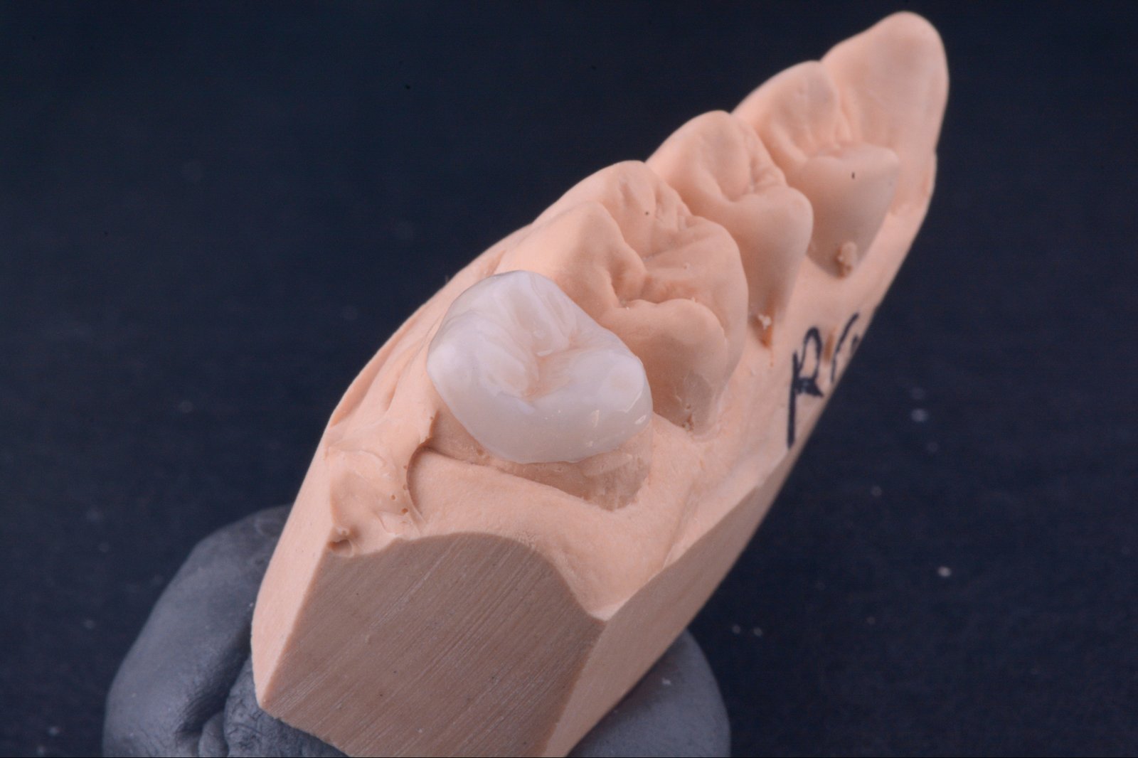Inlays & Onlays