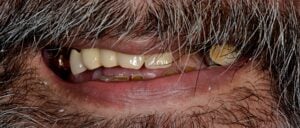 Denture and implants Before