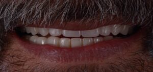 Denture and implants After