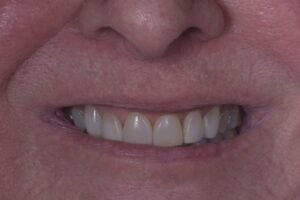 One Arch Dental Implant After