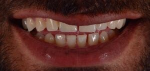 Single Implant After