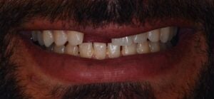 Single implant Before