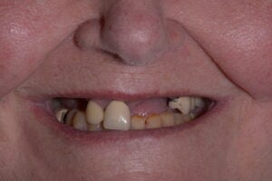 One Arch Dental Implant Before