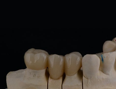 photo-of-a-dental-bridges-model