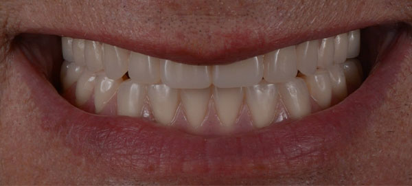 Close-photo-of-a-front-teeth-after-Dentures-and-Implants-dental-procedures