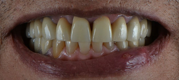 Close-photo-of-a-front-teeth-after-Dentures-and-Implants-procedures