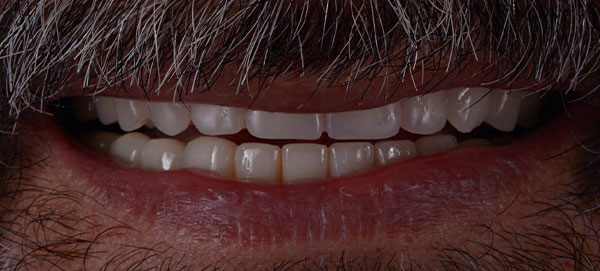 Close-photo-of-a-front-teeth-after-Dentures-and-Implants-were-installed