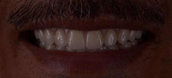 Close-photo-of-a-front-teeth-after-dentures-procedures