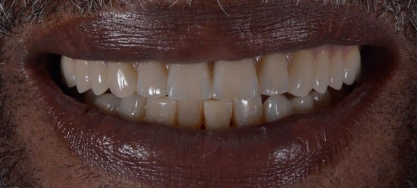 close-photo-of-a-front-teeth-after-all-on-four-dental-procedures
