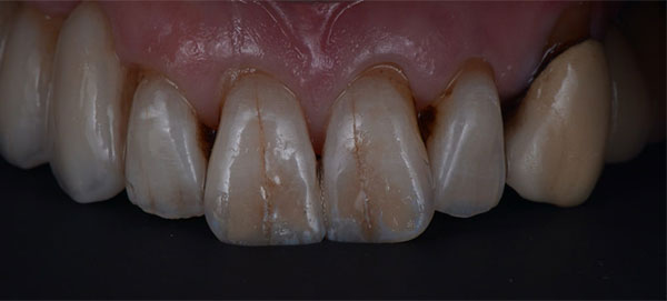 close-photo-of-a-front-teeth-after-dental-procedures